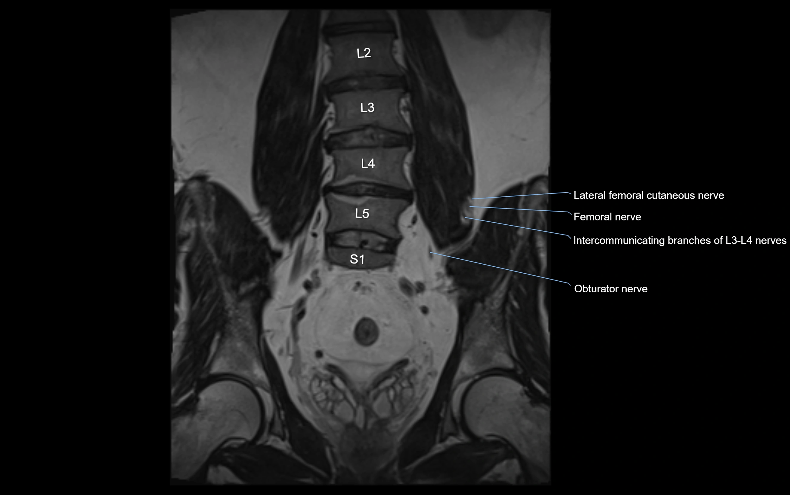 MR lumbosacral plexus cross sectional anatomy 3T  radiology  image-img-09001-00029.webp